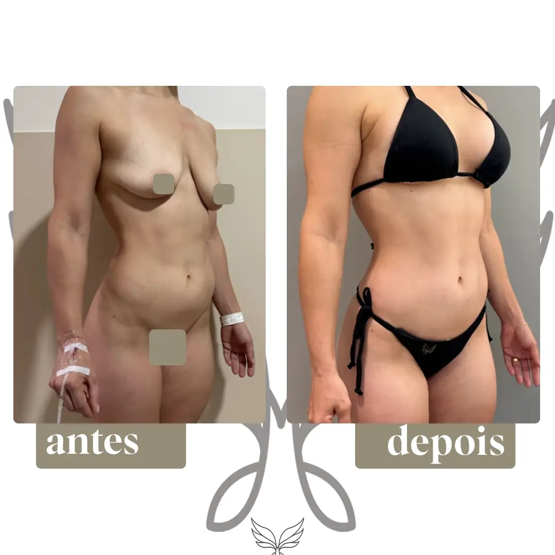 Antes e depois, registro autorizado pela paciente