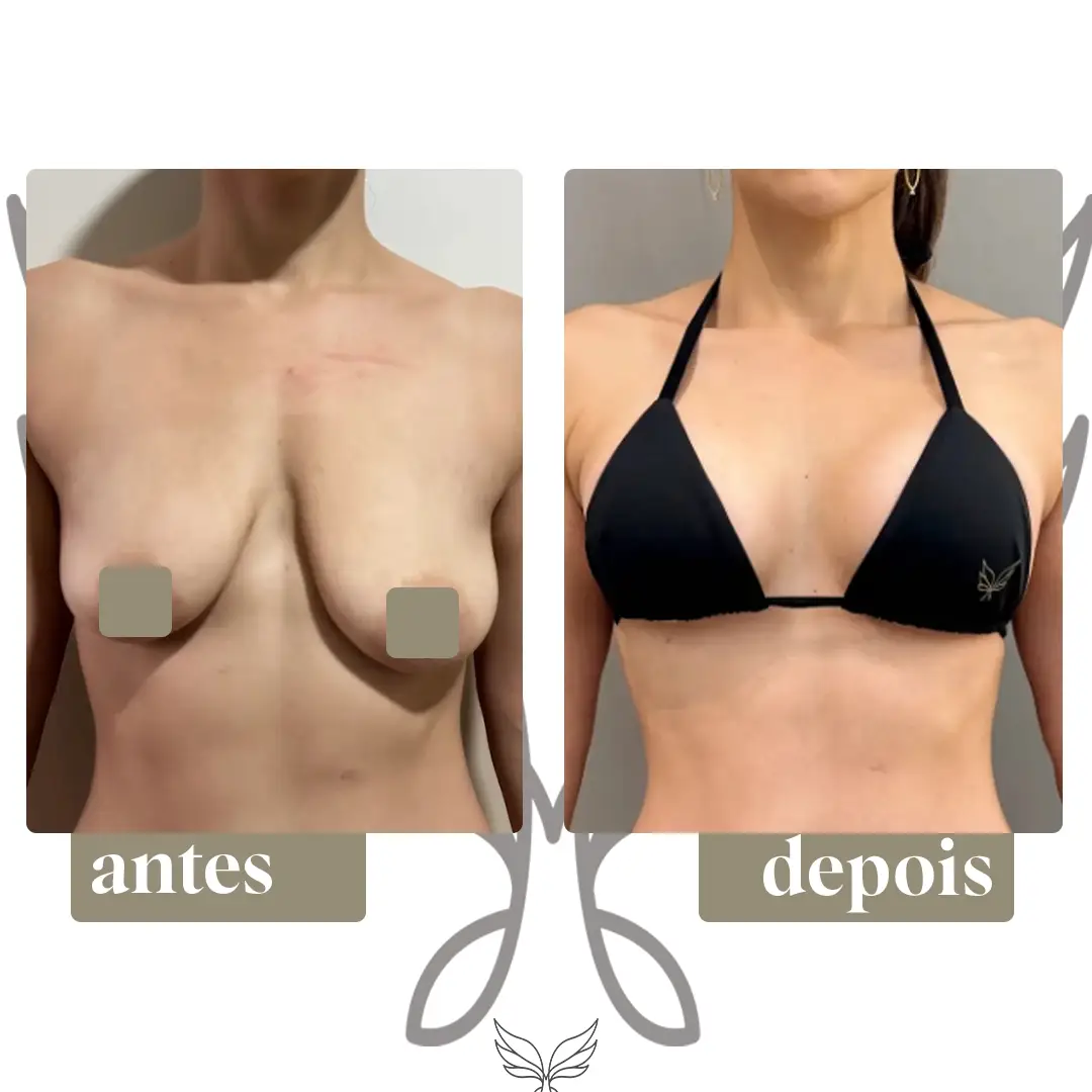 Antes e depois, registro autorizado pela paciente