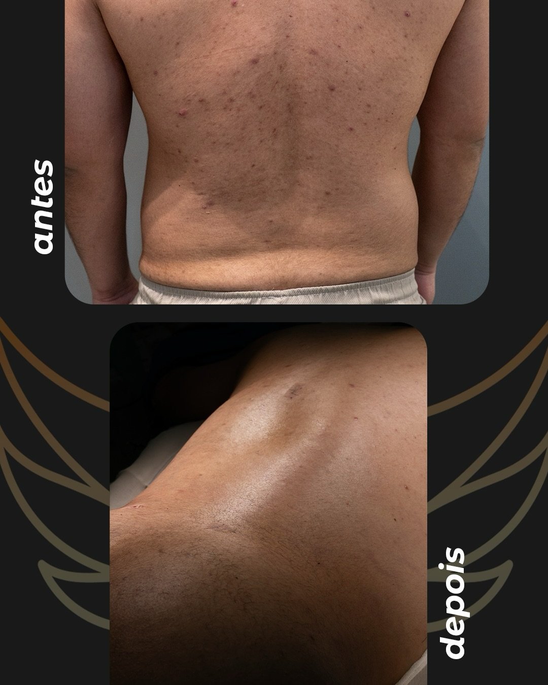 Antes e depois, registro autorizado pela paciente