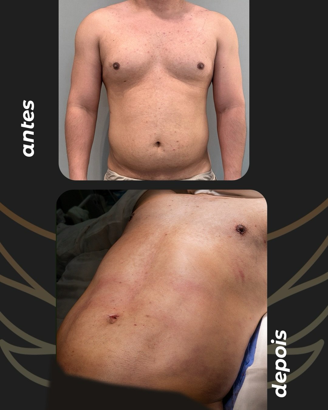 Antes e depois, registro autorizado pela paciente