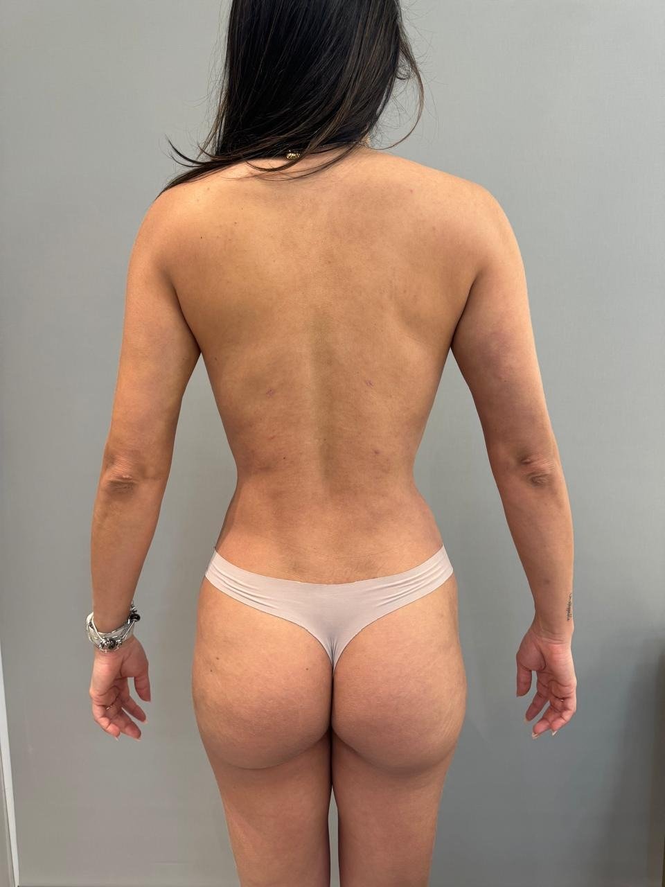 Antes e depois, registro autorizado pela paciente